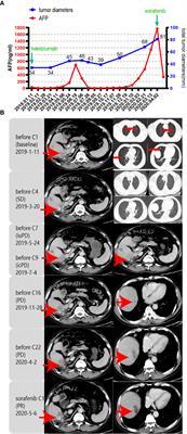 Case Report: Clinical Responses to Tislelizumab as a First-Line Therapy for Primary Hepatocellular Carcinoma With B-Cell Indolent Lymphoma